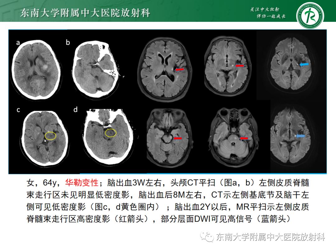 影像PPT - 【PPT】华勒变性-17