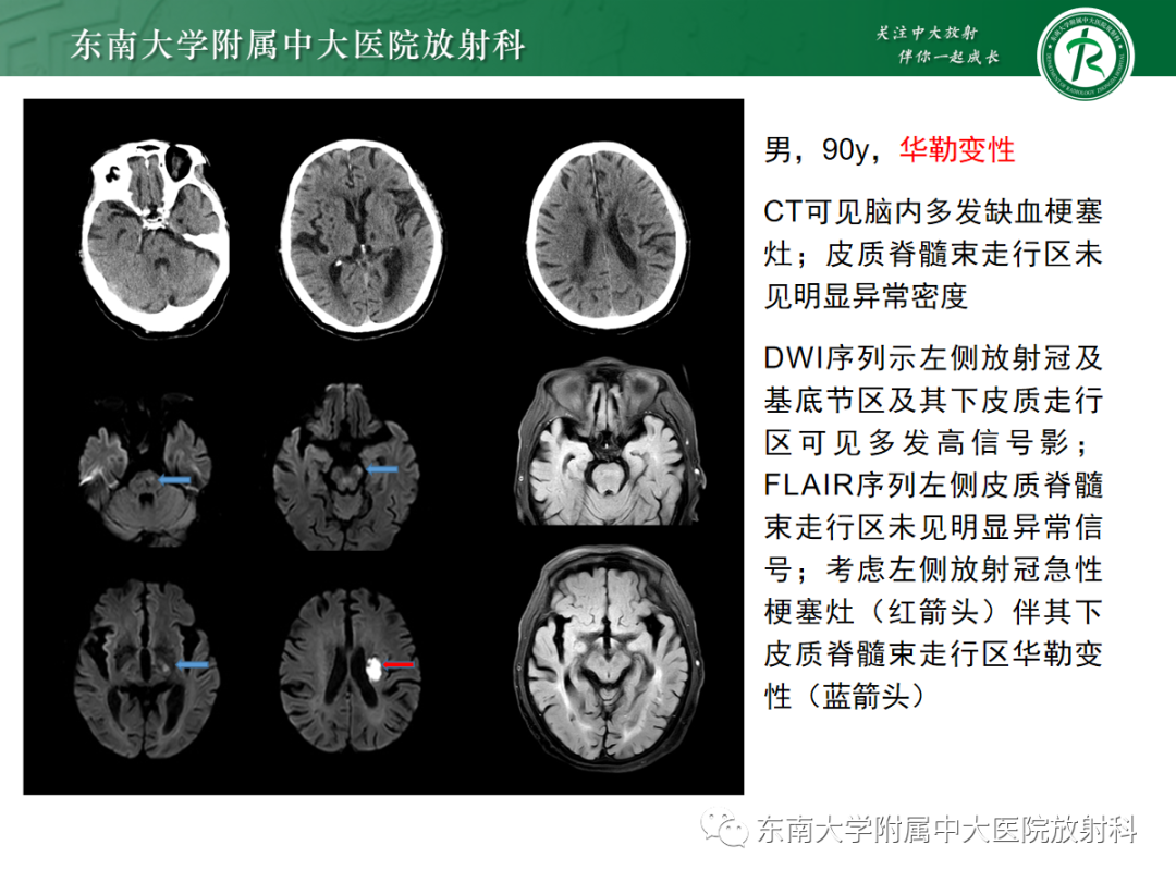 影像PPT - 【PPT】华勒变性-16