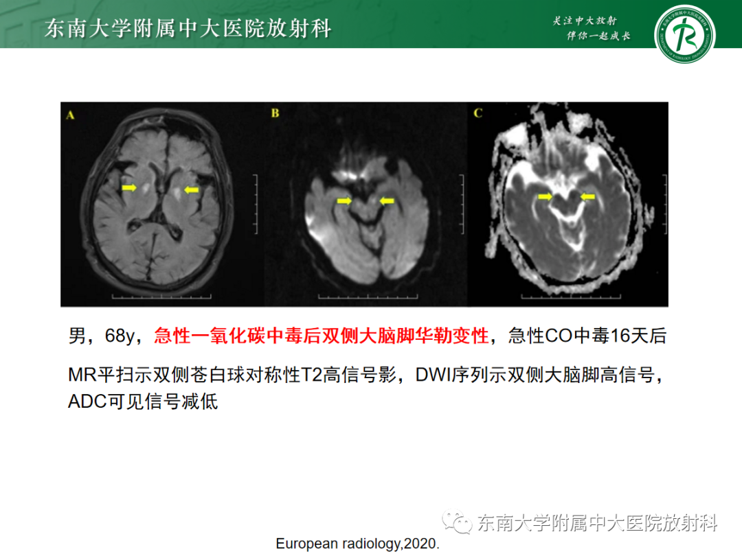 影像PPT - 【PPT】华勒变性-20