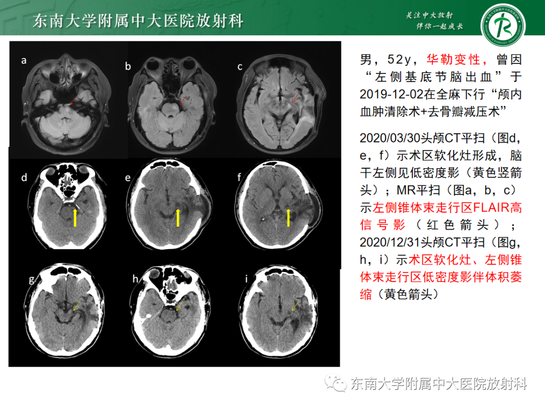 影像PPT - 【PPT】华勒变性-19