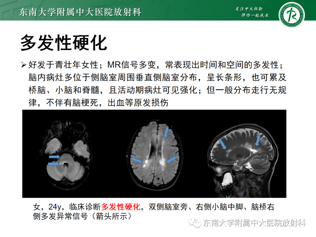 影像PPT - 【PPT】华勒变性-24