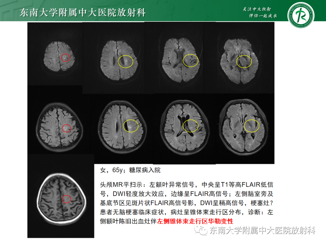 影像PPT - 【PPT】华勒变性-23