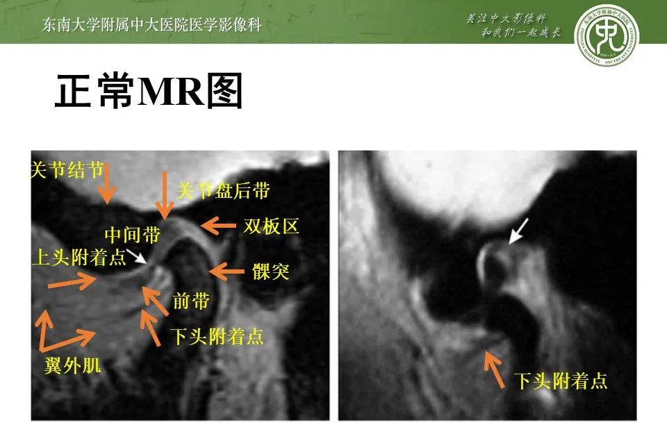 影像PPT - 【PPT】颞下颌关节紊乱病影像诊断-13