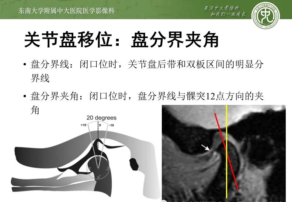 影像PPT - 【PPT】颞下颌关节紊乱病影像诊断-18