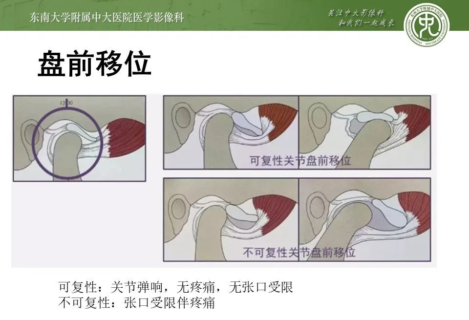 影像PPT - 【PPT】颞下颌关节紊乱病影像诊断-19