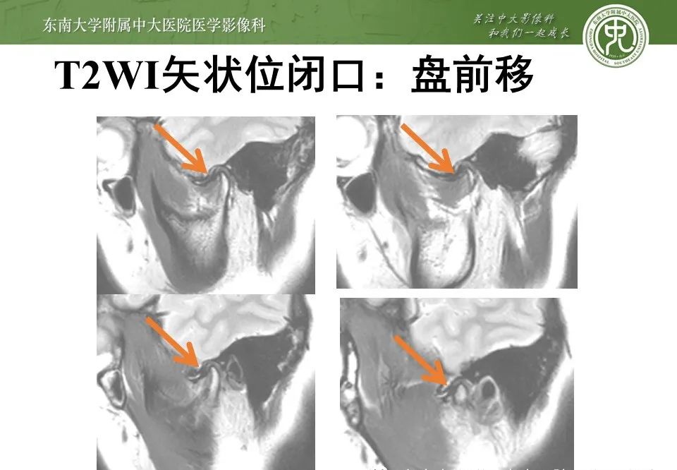 影像PPT - 【PPT】颞下颌关节紊乱病影像诊断-21