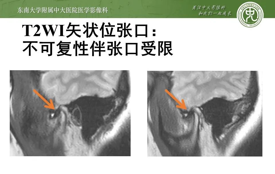 影像PPT - 【PPT】颞下颌关节紊乱病影像诊断-22