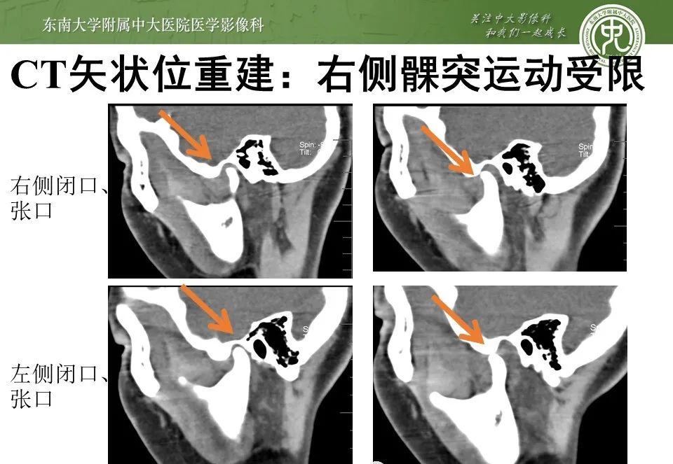 影像PPT - 【PPT】颞下颌关节紊乱病影像诊断-20