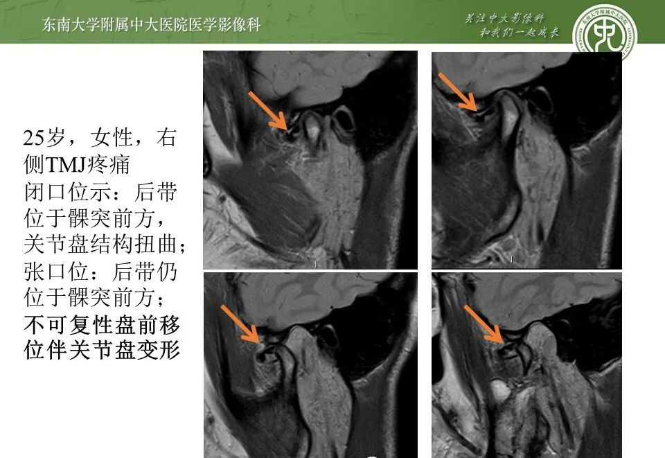 影像PPT - 【PPT】颞下颌关节紊乱病影像诊断-24