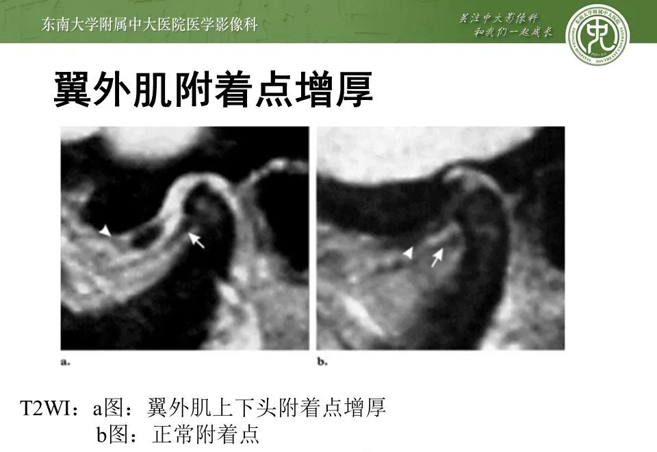 影像PPT - 【PPT】颞下颌关节紊乱病影像诊断-26