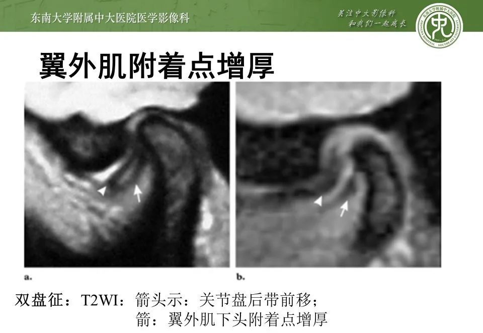 影像PPT - 【PPT】颞下颌关节紊乱病影像诊断-27