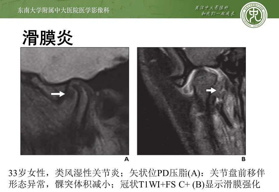 影像PPT - 【PPT】颞下颌关节紊乱病影像诊断-29