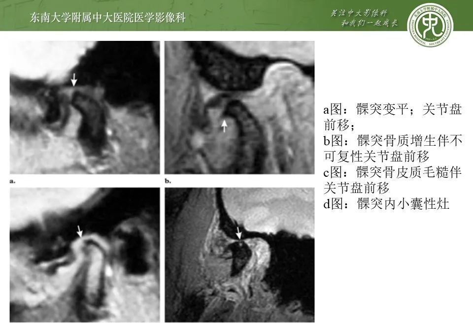 影像PPT - 【PPT】颞下颌关节紊乱病影像诊断-31