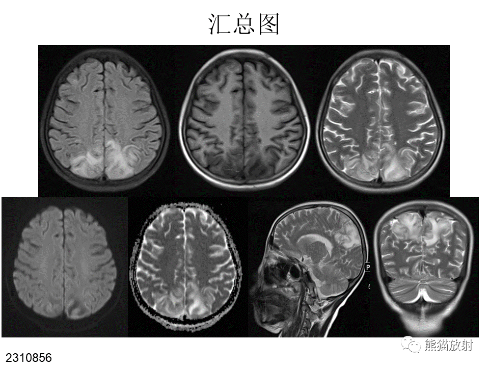 影像PPT - 【病例】可逆性后部脑病综合征2例MR影像-10