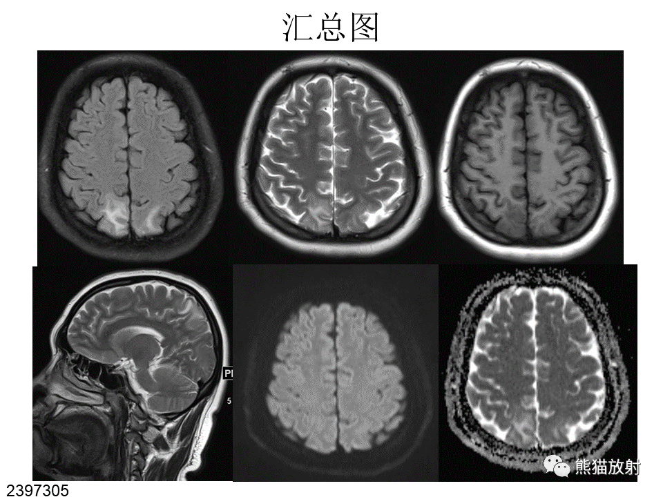 影像PPT - 【病例】可逆性后部脑病综合征2例MR影像-19