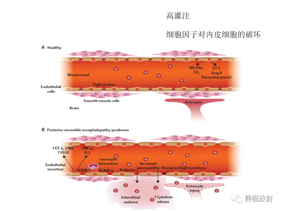 影像PPT - 【病例】可逆性后部脑病综合征2例MR影像-24