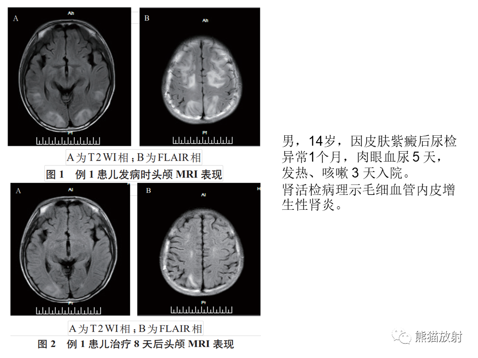 影像PPT - 【病例】可逆性后部脑病综合征2例MR影像-29