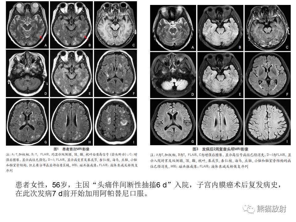 影像PPT - 【病例】可逆性后部脑病综合征2例MR影像-30