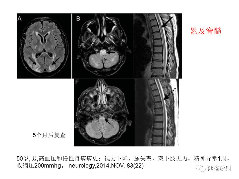 影像PPT - 【病例】可逆性后部脑病综合征2例MR影像-36