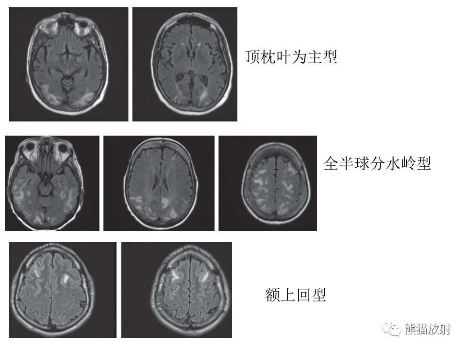 影像PPT - 【病例】可逆性后部脑病综合征2例MR影像-35