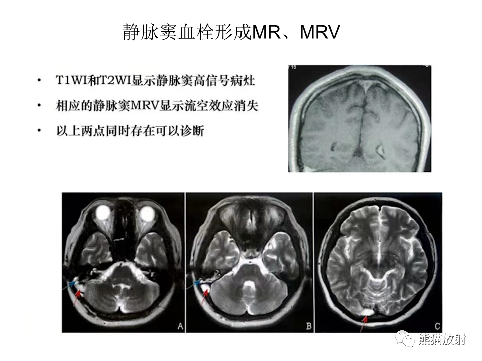 影像PPT - 【病例】可逆性后部脑病综合征2例MR影像-40