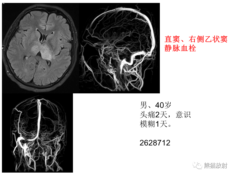 影像PPT - 【病例】可逆性后部脑病综合征2例MR影像-41
