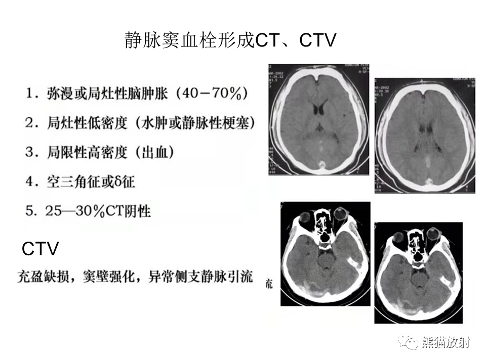 影像PPT - 【病例】可逆性后部脑病综合征2例MR影像-39