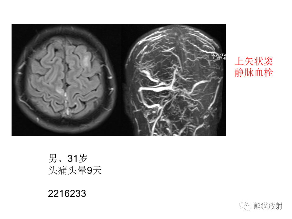 影像PPT - 【病例】可逆性后部脑病综合征2例MR影像-42