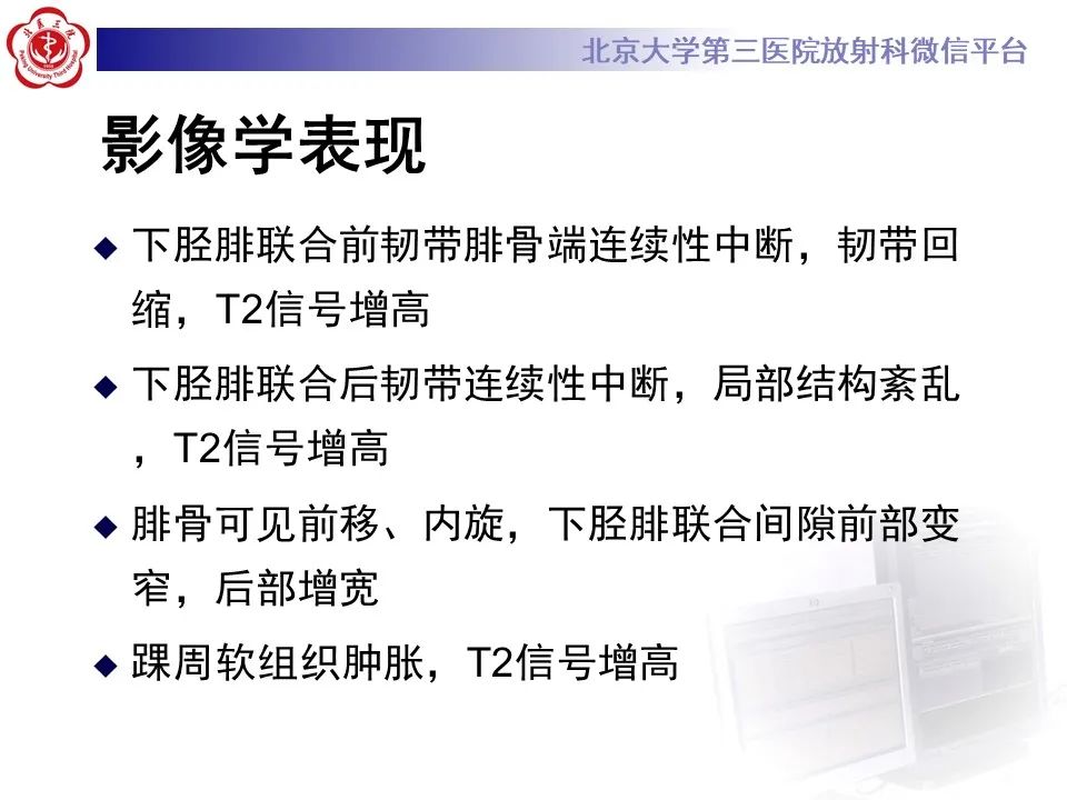影像PPT - 【PPT】下胫腓联合损伤的影像-4