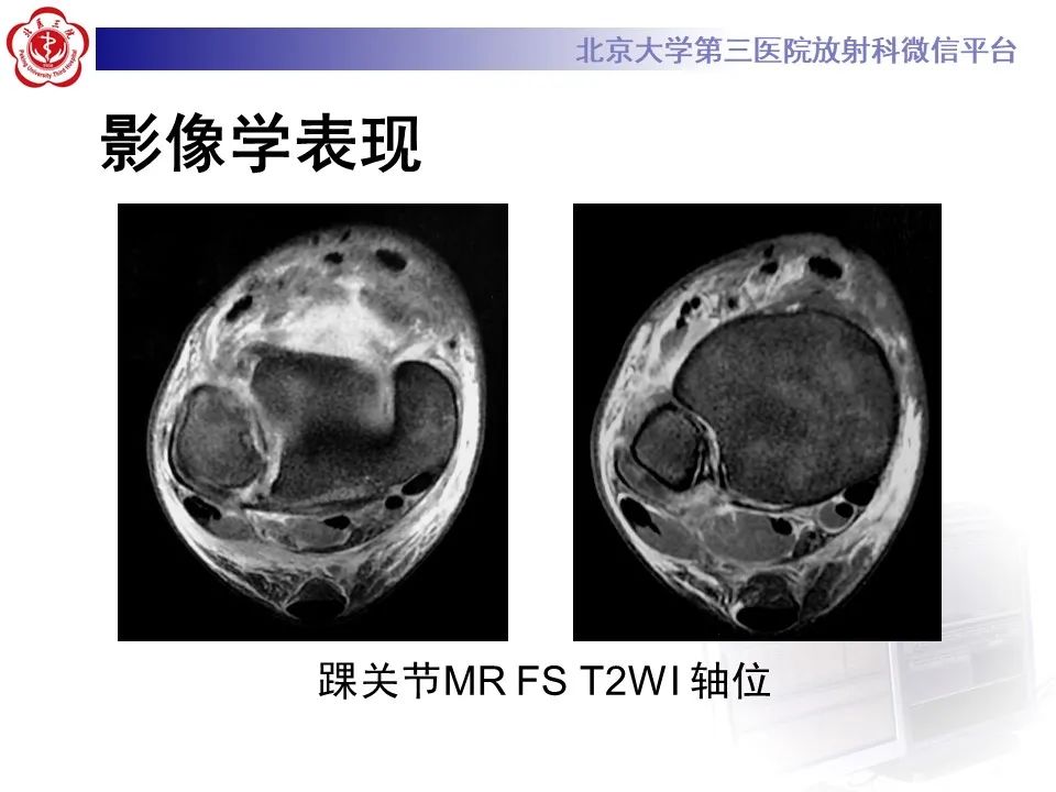 影像PPT - 【PPT】下胫腓联合损伤的影像-2