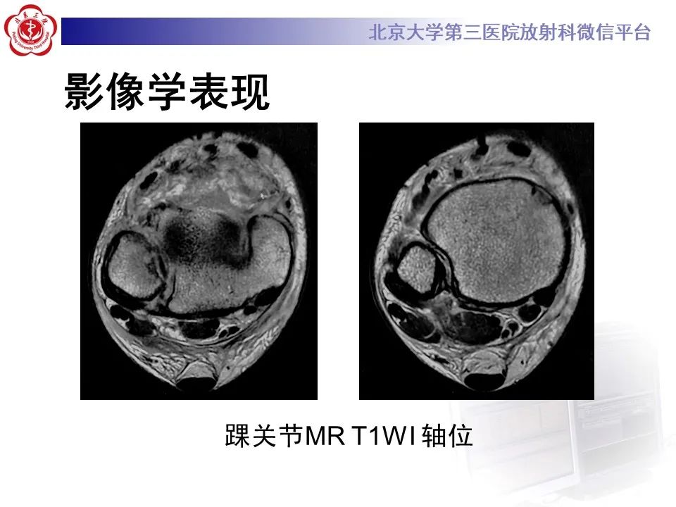 影像PPT - 【PPT】下胫腓联合损伤的影像-3