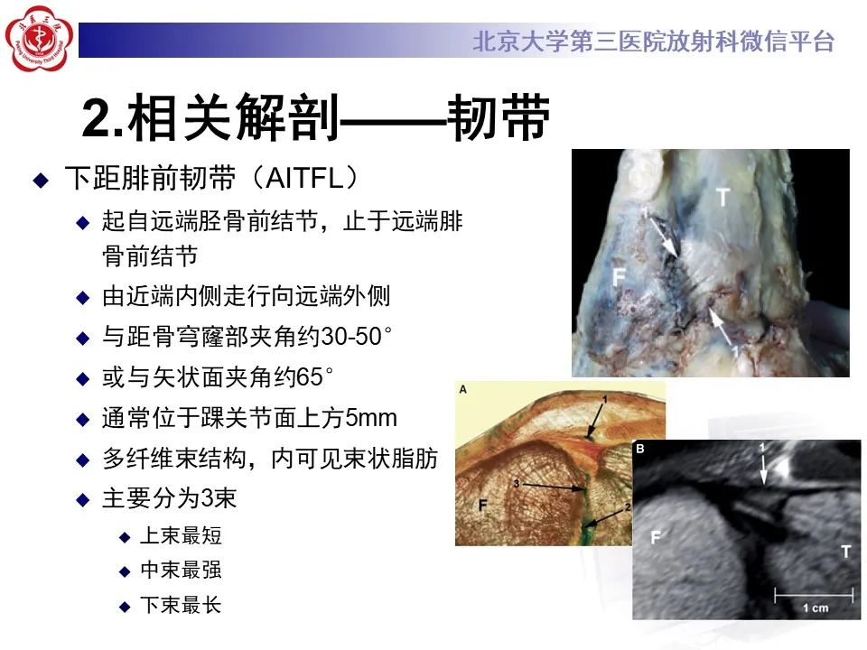 影像PPT - 【PPT】下胫腓联合损伤的影像-10