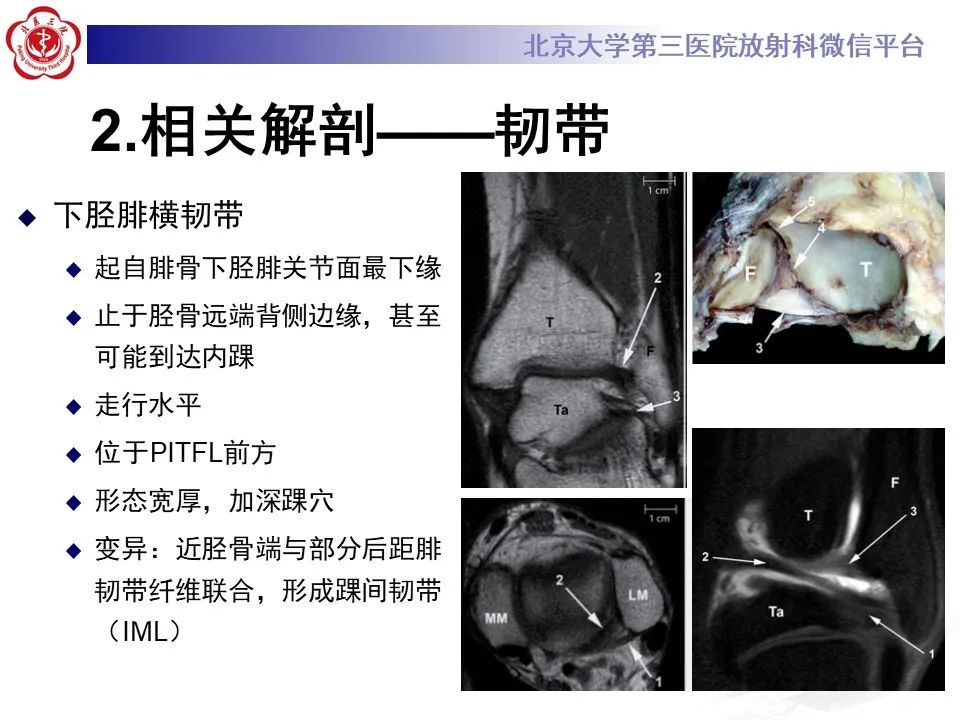 影像PPT - 【PPT】下胫腓联合损伤的影像-12
