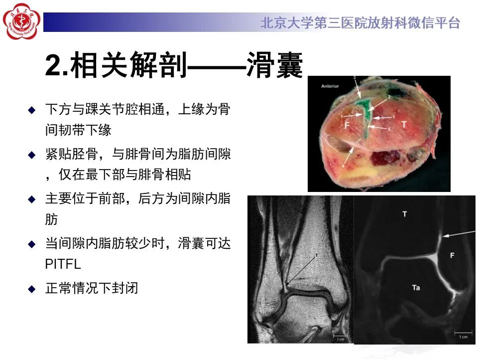 影像PPT - 【PPT】下胫腓联合损伤的影像-14