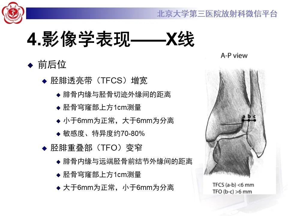 影像PPT - 【PPT】下胫腓联合损伤的影像-16