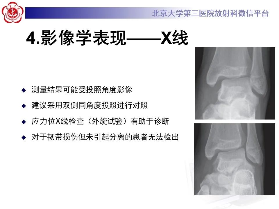 影像PPT - 【PPT】下胫腓联合损伤的影像-18