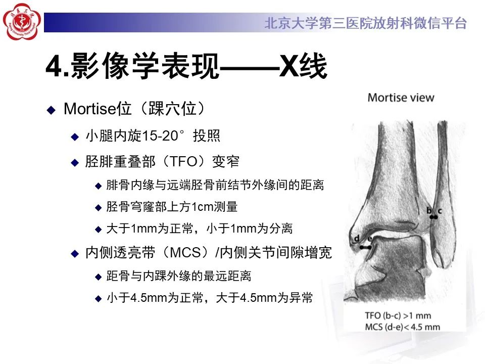影像PPT - 【PPT】下胫腓联合损伤的影像-17