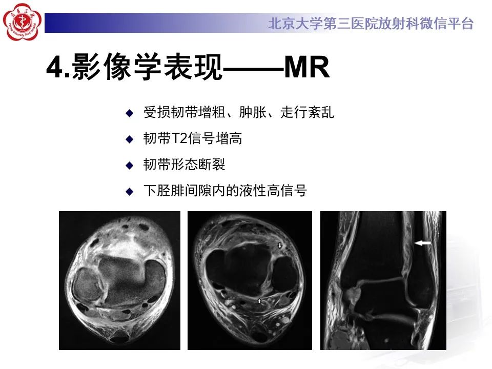 影像PPT - 【PPT】下胫腓联合损伤的影像-20