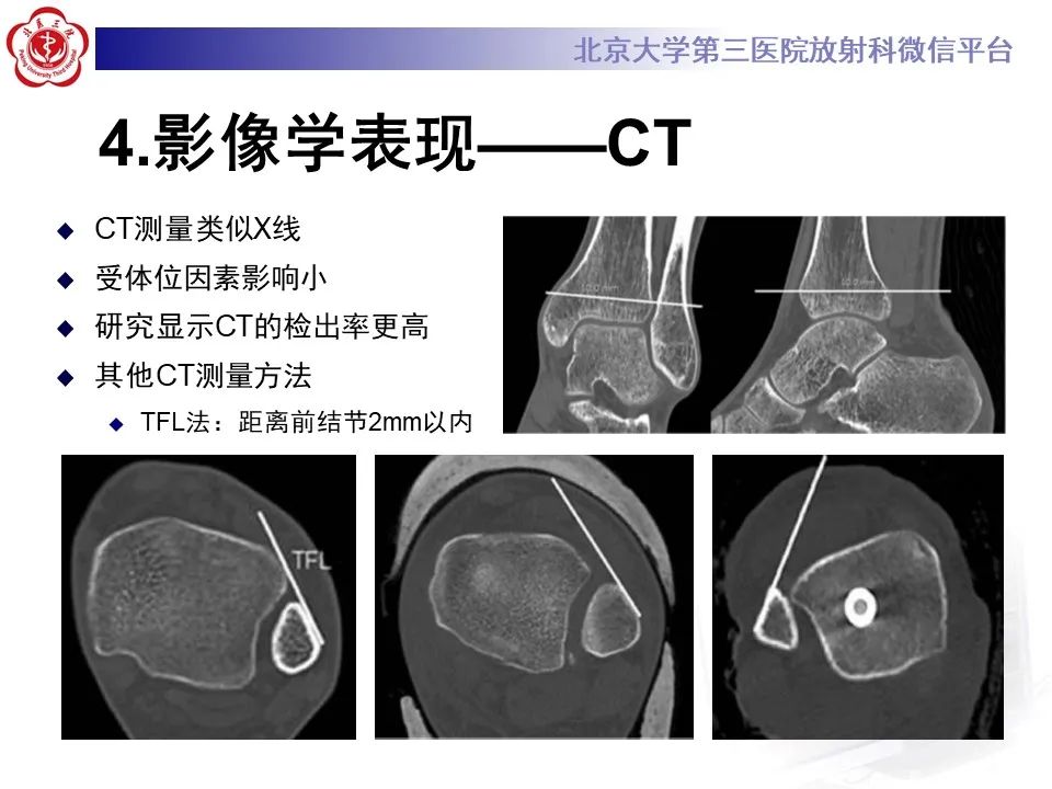 影像PPT - 【PPT】下胫腓联合损伤的影像-19