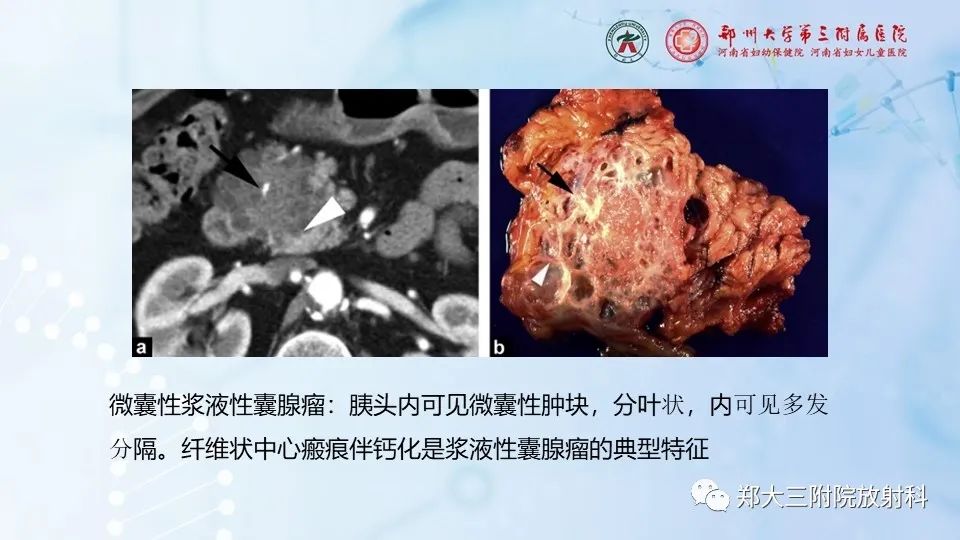 影像PPT - 【PPT】胰腺良性上皮性肿瘤及癌前病变-18