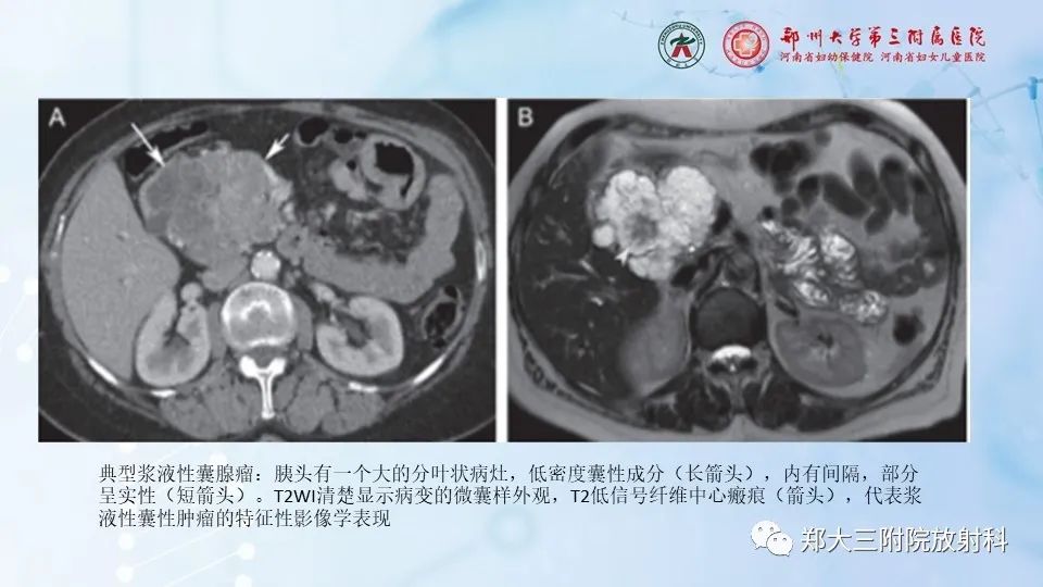 影像PPT - 【PPT】胰腺良性上皮性肿瘤及癌前病变-19