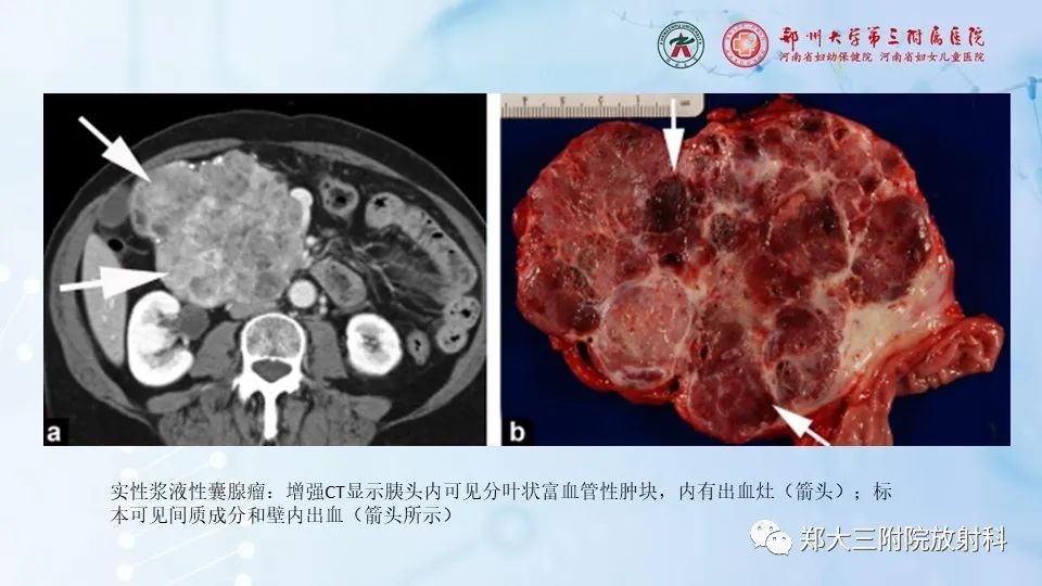 影像PPT - 【PPT】胰腺良性上皮性肿瘤及癌前病变-21