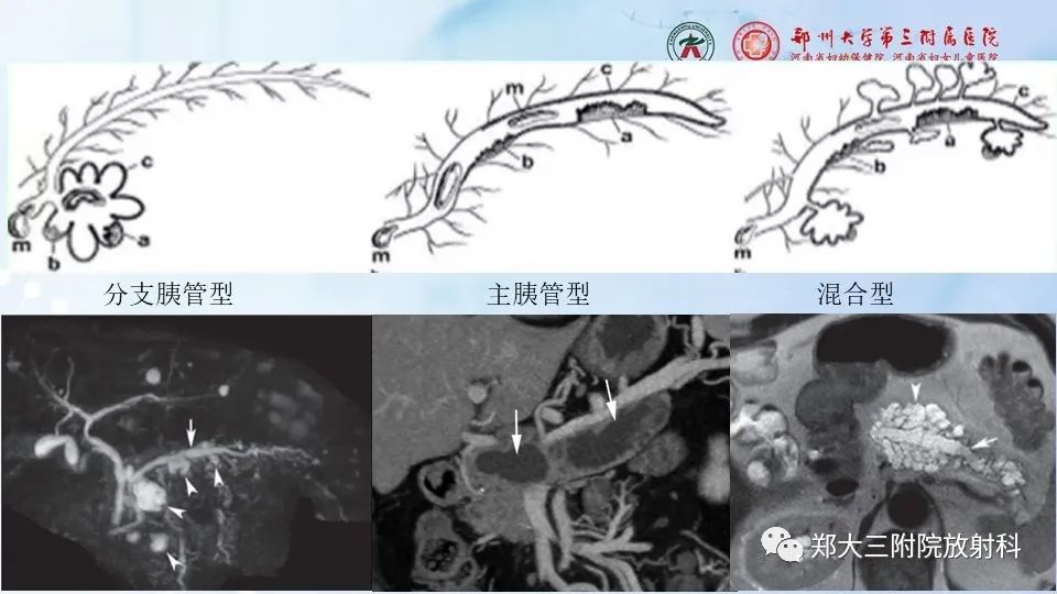 影像PPT - 【PPT】胰腺良性上皮性肿瘤及癌前病变-26