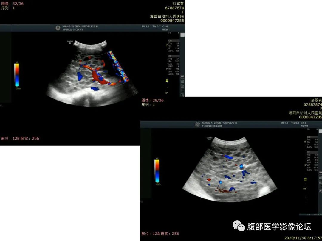 影像PPT - 【病例】肝脏弥漫B细胞淋巴瘤1例CT及MR-5