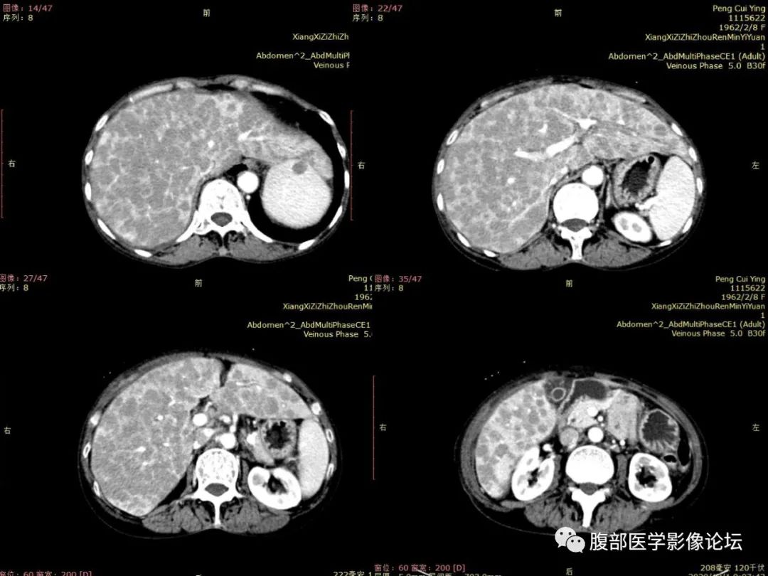 影像PPT - 【病例】肝脏弥漫B细胞淋巴瘤1例CT及MR-8