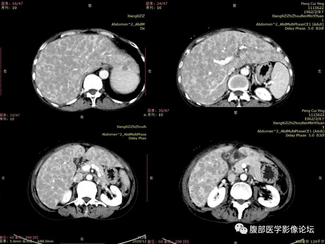 影像PPT - 【病例】肝脏弥漫B细胞淋巴瘤1例CT及MR-9