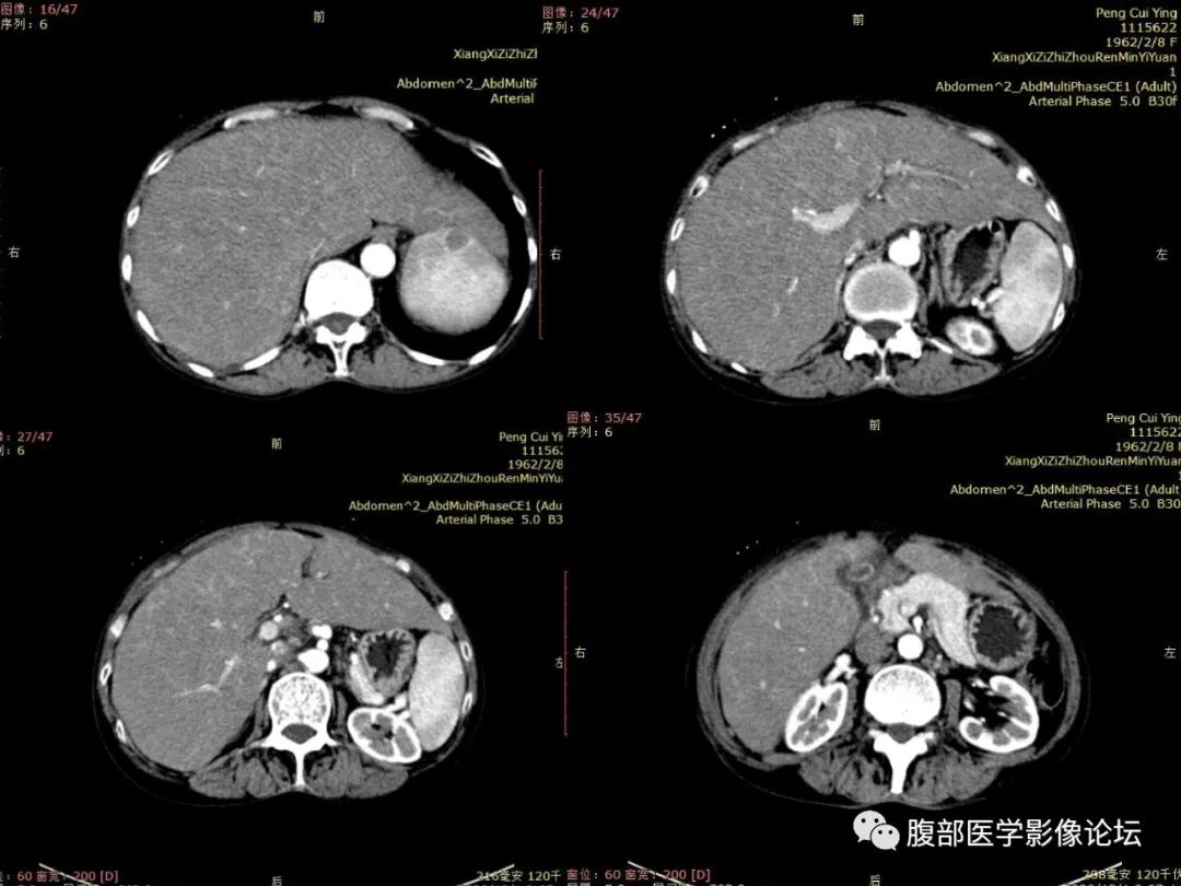 影像PPT - 【病例】肝脏弥漫B细胞淋巴瘤1例CT及MR-7