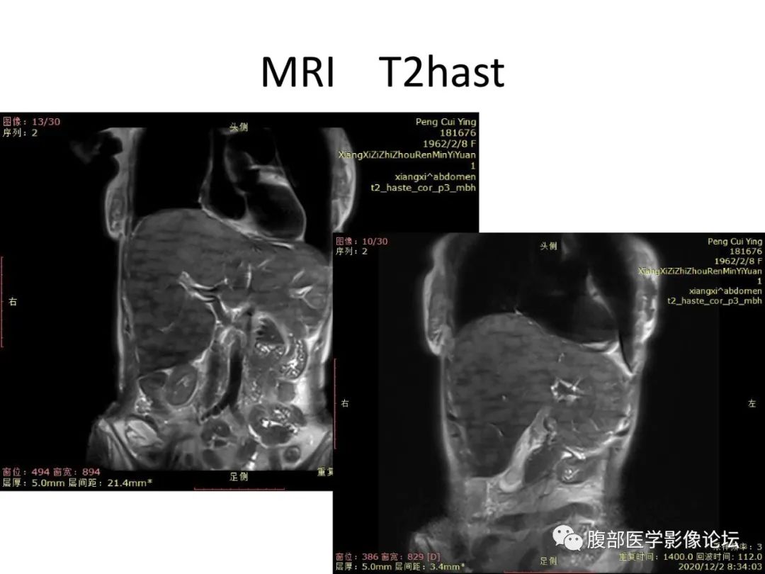影像PPT - 【病例】肝脏弥漫B细胞淋巴瘤1例CT及MR-11
