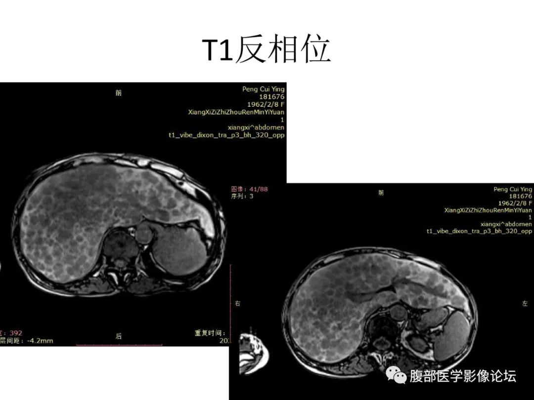 影像PPT - 【病例】肝脏弥漫B细胞淋巴瘤1例CT及MR-12