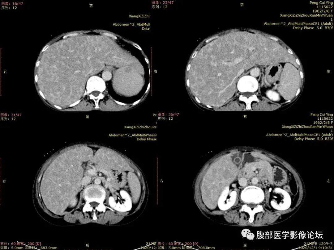 影像PPT - 【病例】肝脏弥漫B细胞淋巴瘤1例CT及MR-10